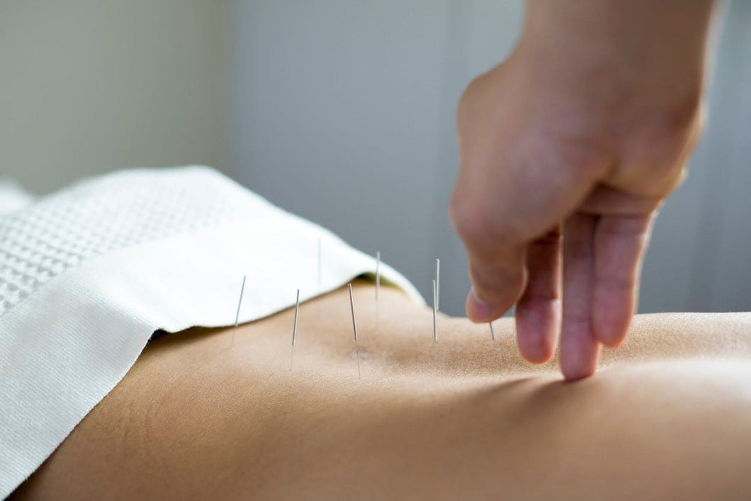 Acupuncture Package of 10 Treatments